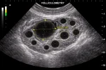 УЗИ фолликулогенеза в Ростове