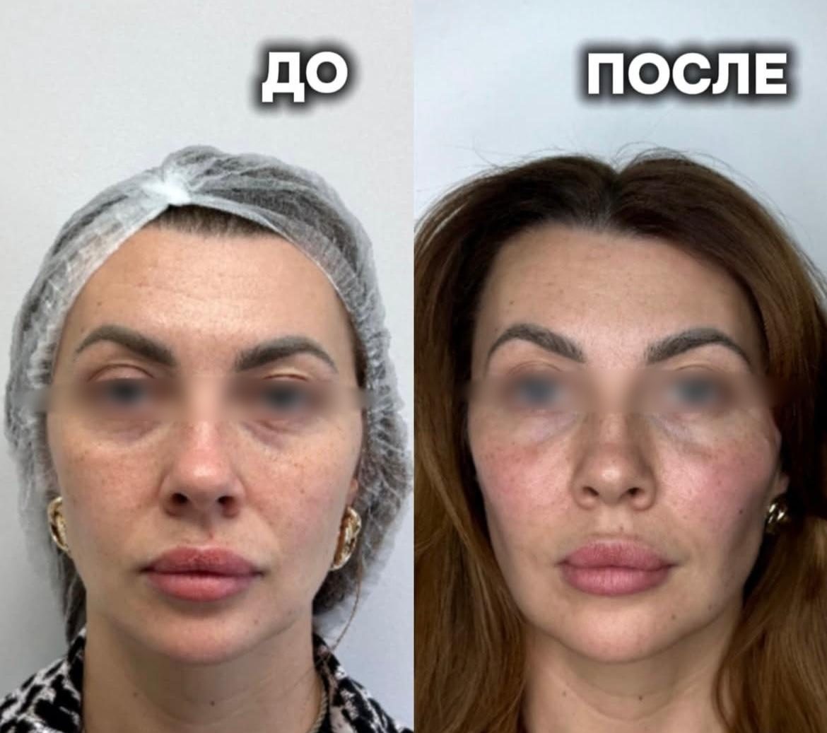 Результат контурной пластики препаратом Radiesse