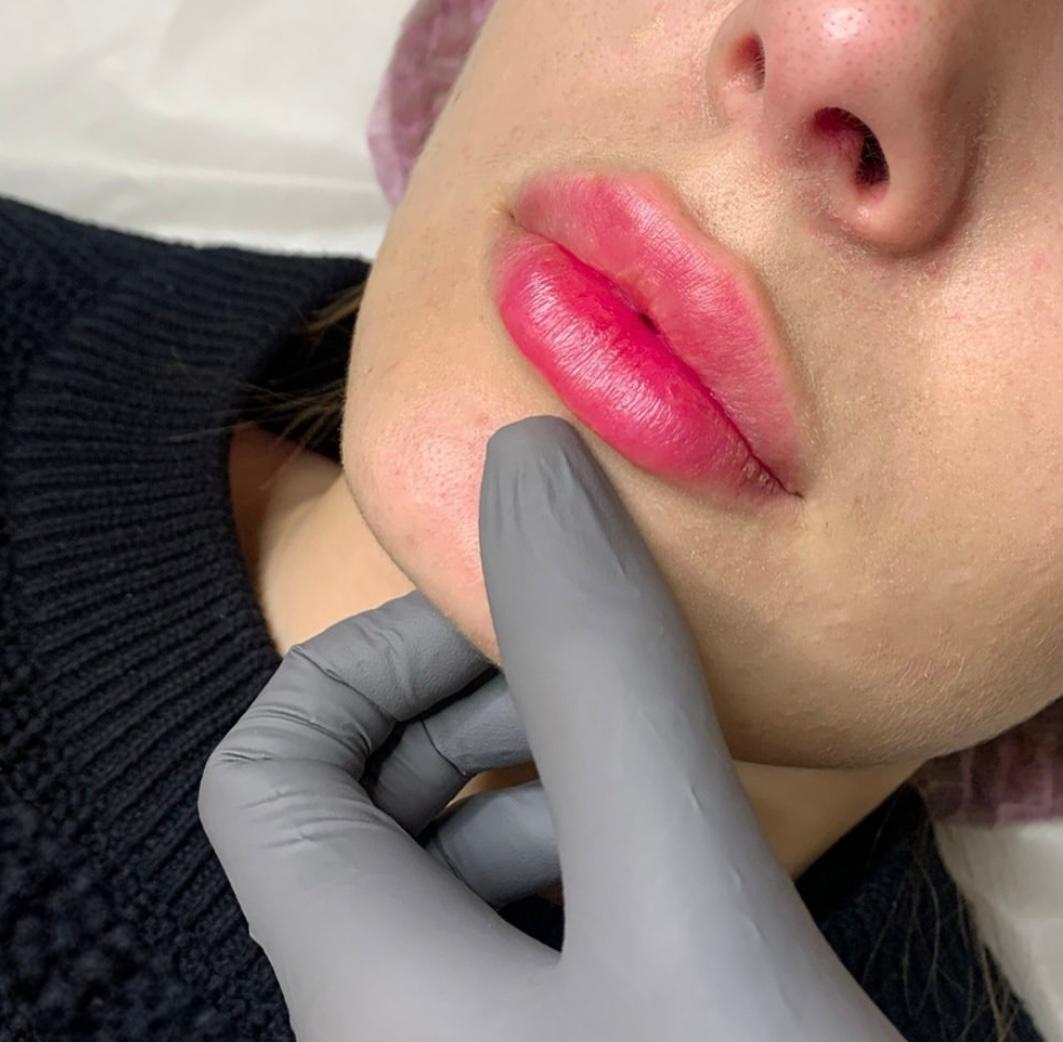 Контурная пластика губ: препараты, объем, техники, эффекты
