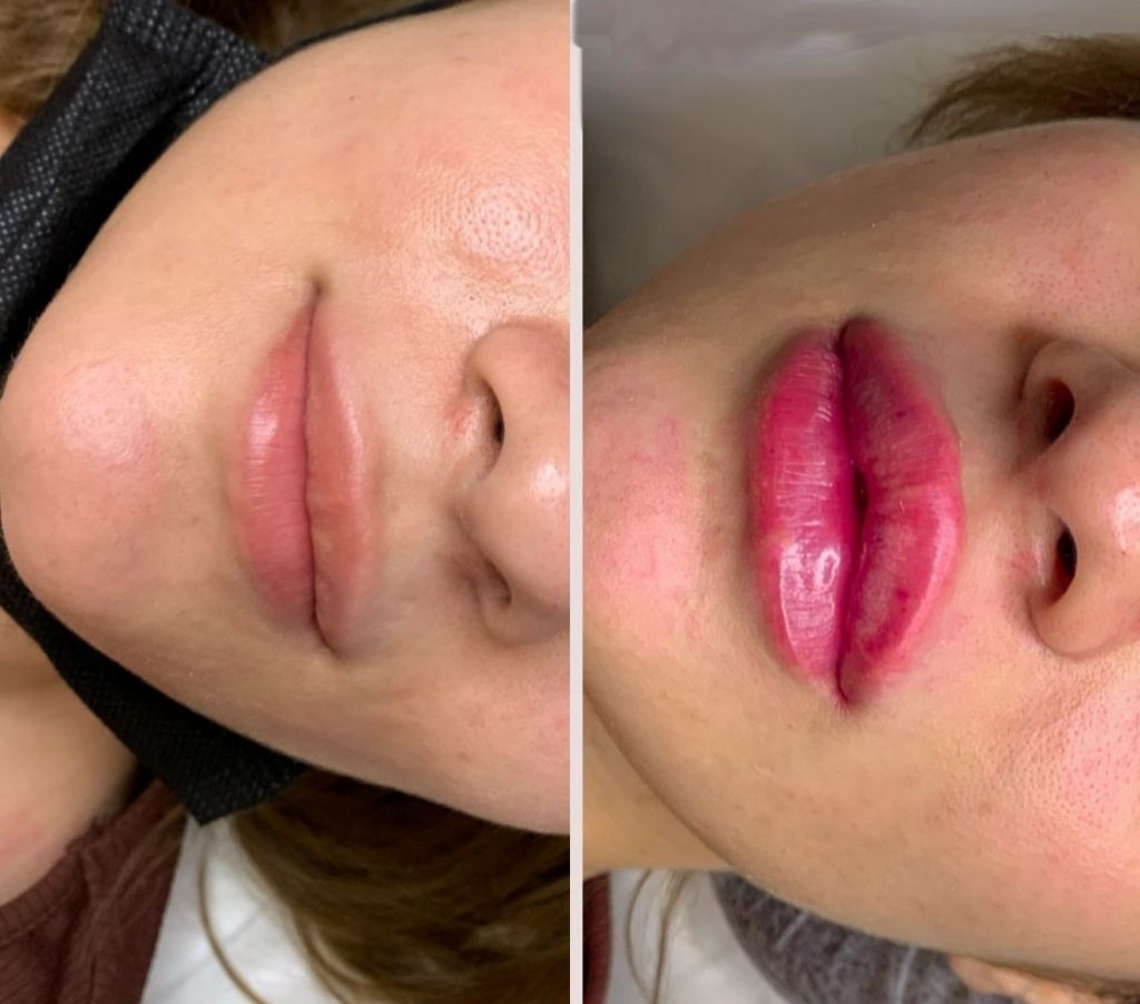 Увеличение губ препаратом Belotero Lips Contour