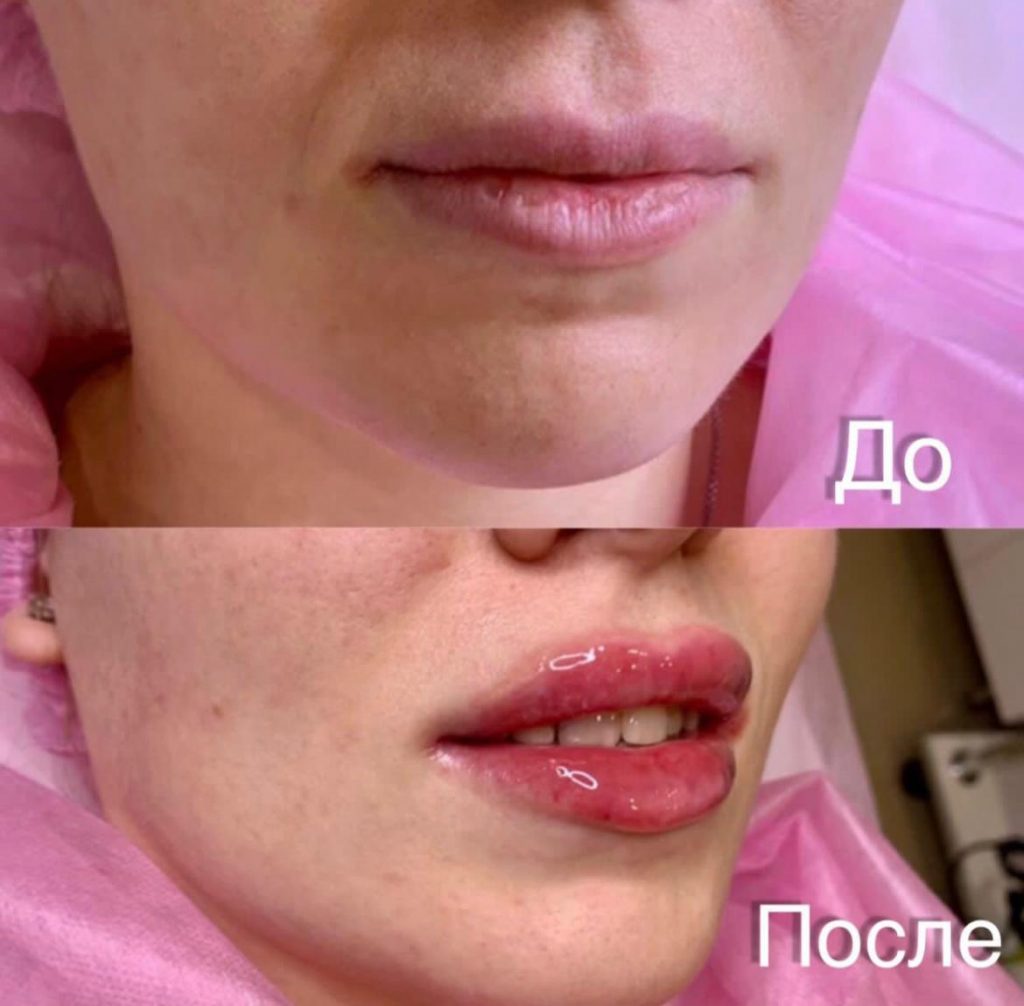 Увеличение губ в Ростове-на-Дону препаратом Belotero Lips Contour