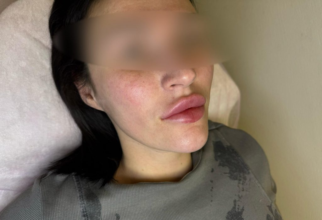 Увеличение губ Belotero Lips Shape