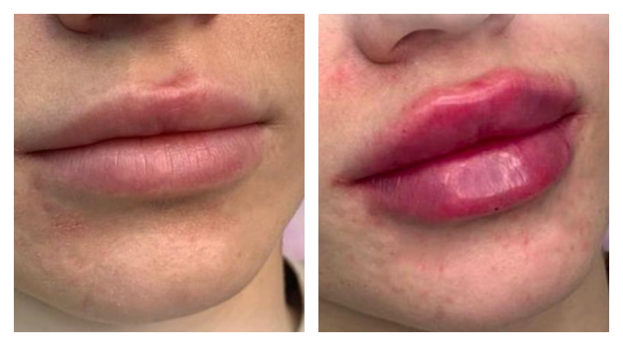 Увеличение губ препаратом Belotero Lips Shape в Ростове
