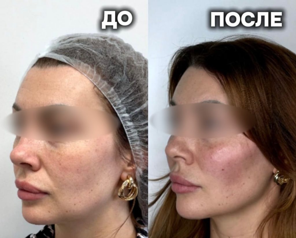 Результаты контурной пластики губ